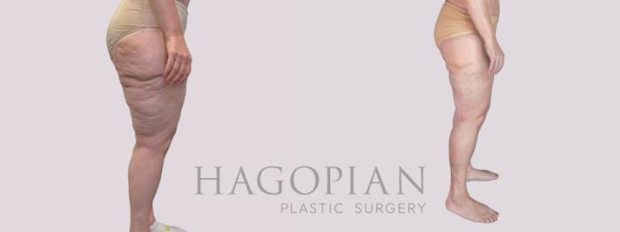 Before & After Thigh Lift Case 281 Right Side View in Atlanta, GA