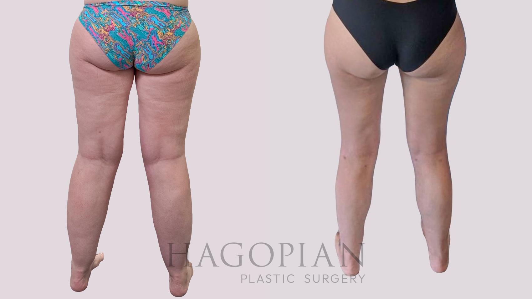 Before & After Thigh Lift Case 289 Back View in Atlanta, GA