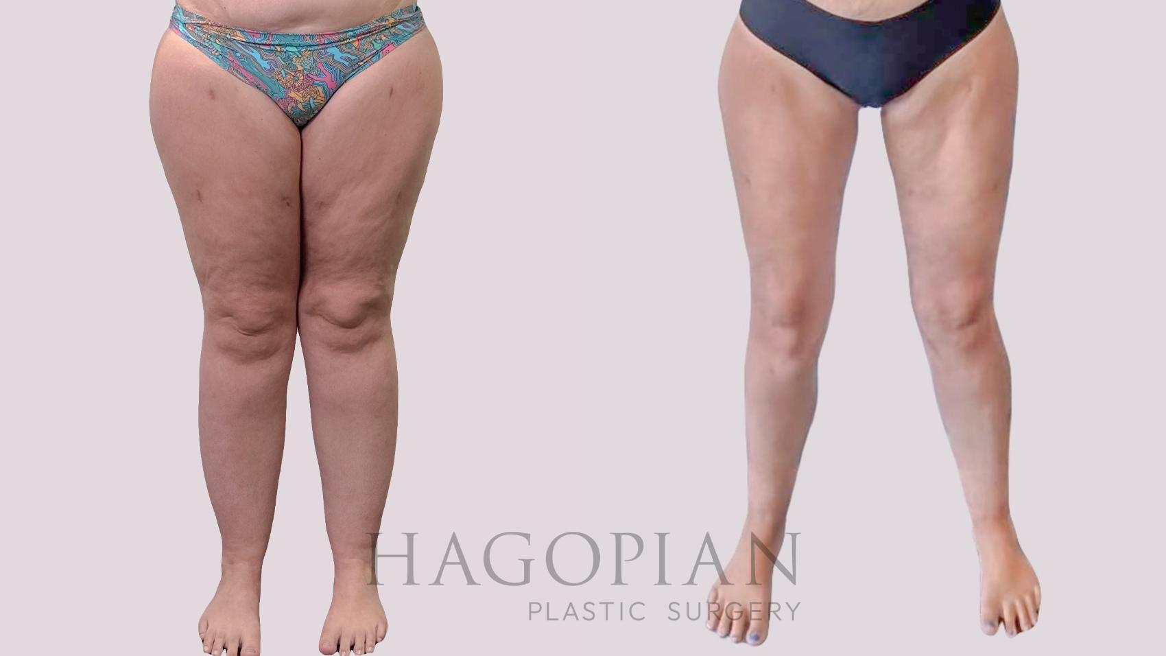 Before & After Thigh Lift Case 289 Front View in Atlanta, GA