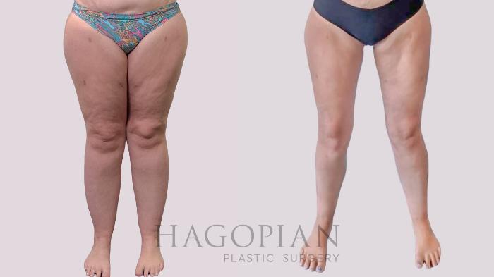 Before & After Thigh Lift Case 289 Front View in Atlanta, GA