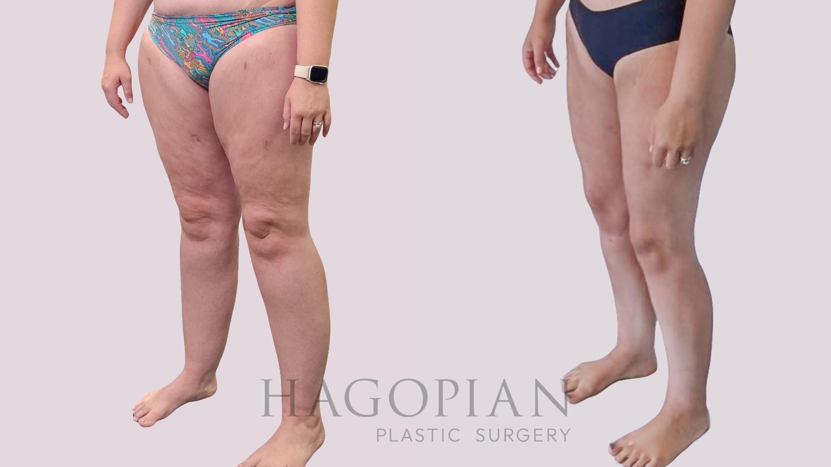 Before & After Thigh Lift Case 289 Left Oblique View in Atlanta, GA