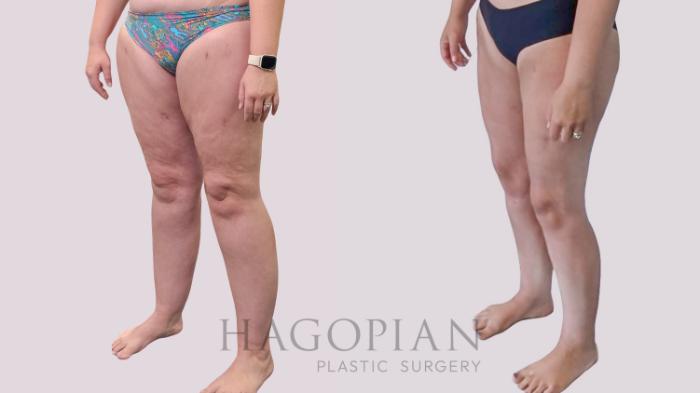 Before & After Thigh Lift Case 289 Left Oblique View in Atlanta, GA
