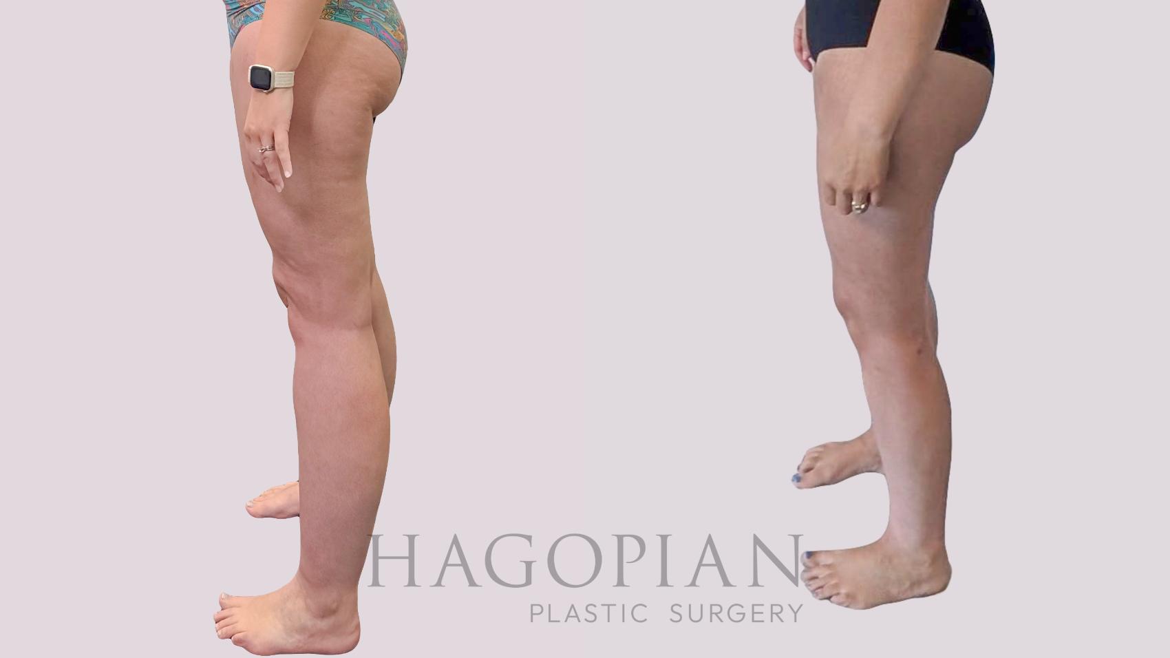 Before & After Thigh Lift Case 289 Left Side View in Atlanta, GA