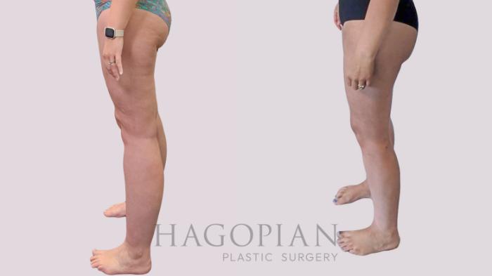 Before & After Thigh Lift Case 289 Left Side View in Atlanta, GA
