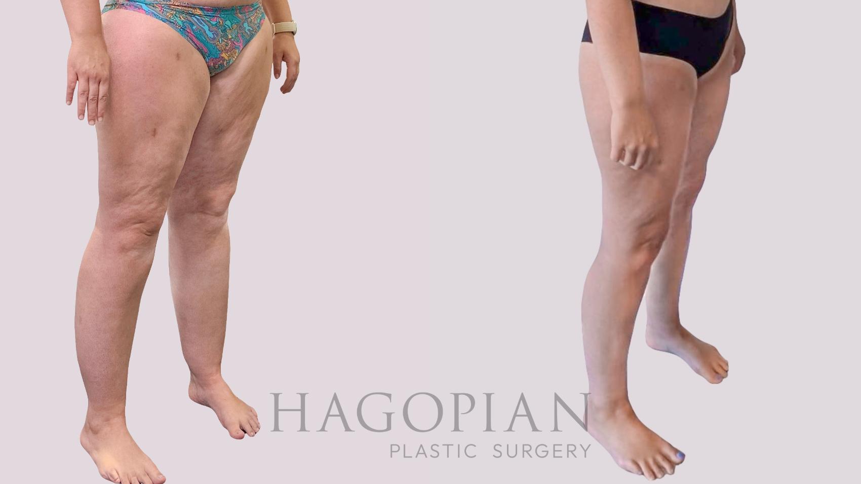 Before & After Thigh Lift Case 289 Right Oblique View in Atlanta, GA