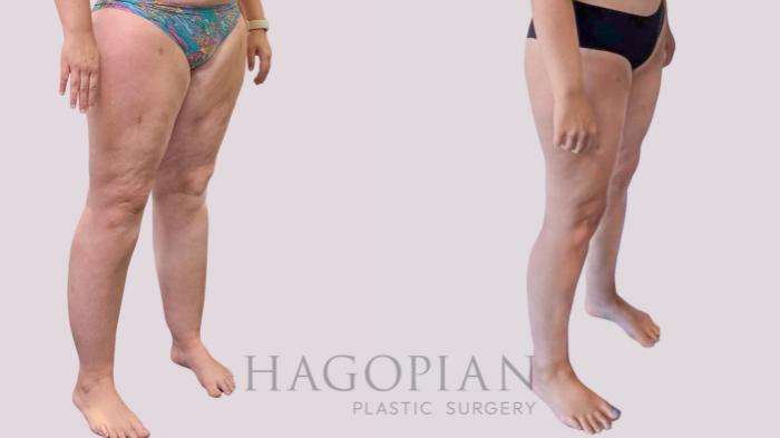 Before & After Thigh Lift Case 289 Right Oblique View in Atlanta, GA