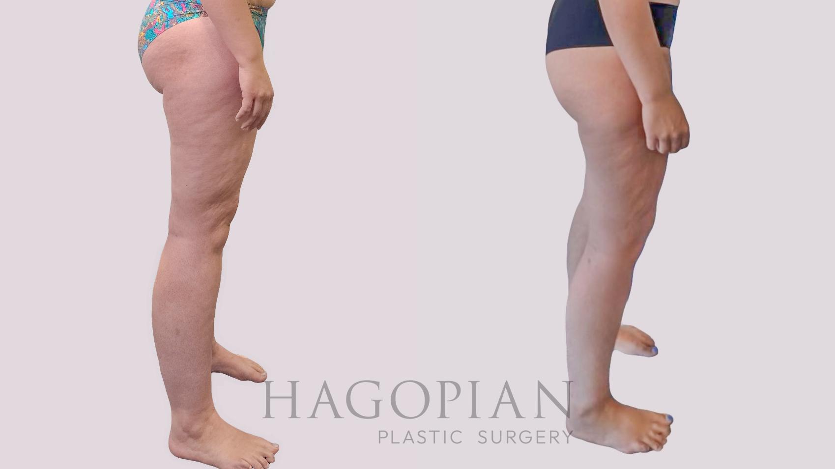 Before & After Thigh Lift Case 289 Right Side View in Atlanta, GA