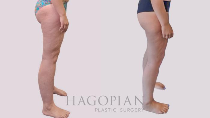 Before & After Thigh Lift Case 289 Right Side View in Atlanta, GA