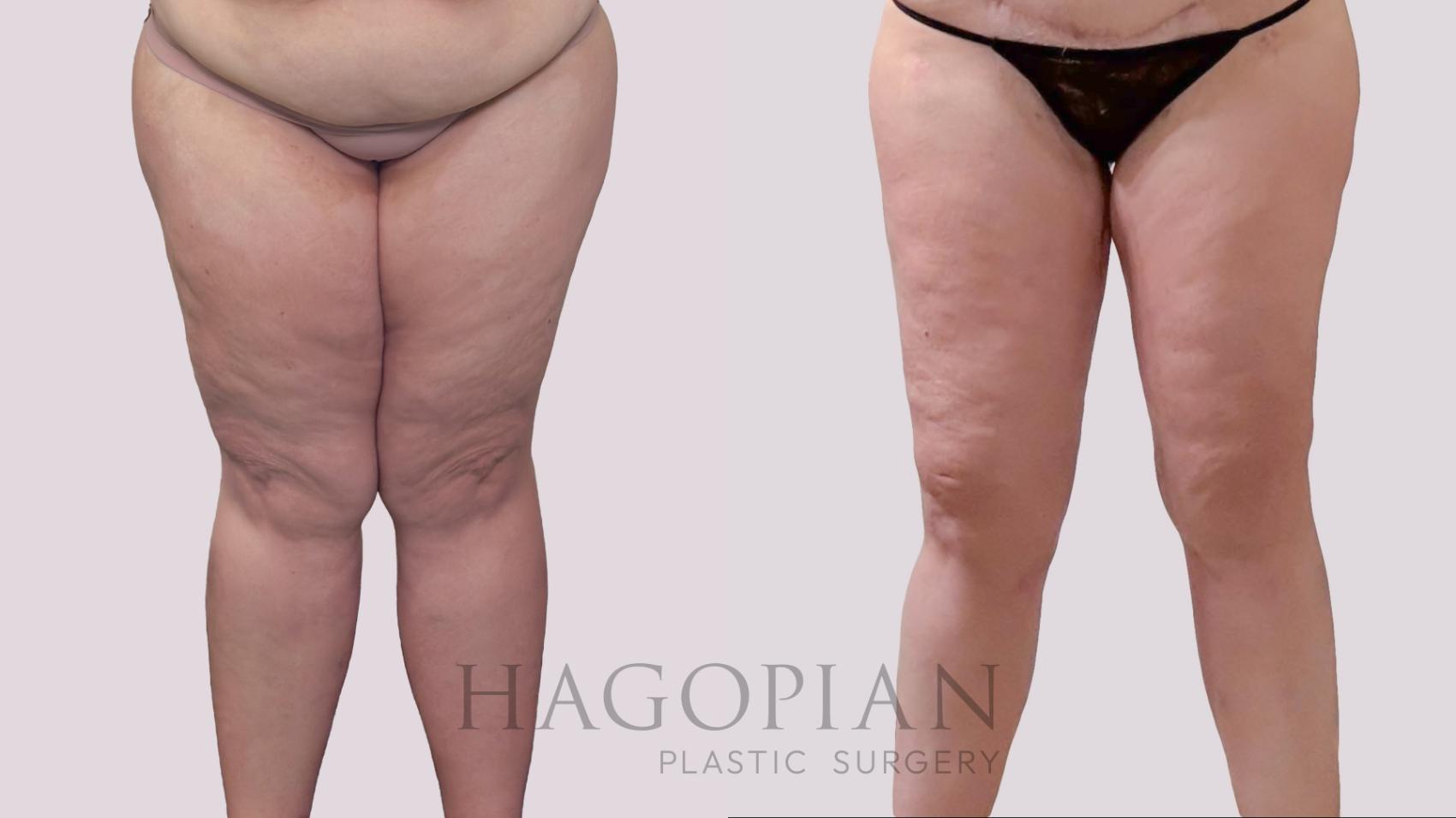 Before & After Thigh Lift Case 293 Front View in Atlanta, GA