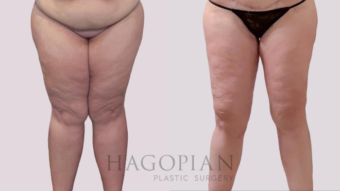 Before & After Thigh Lift Case 293 Front View in Atlanta, GA