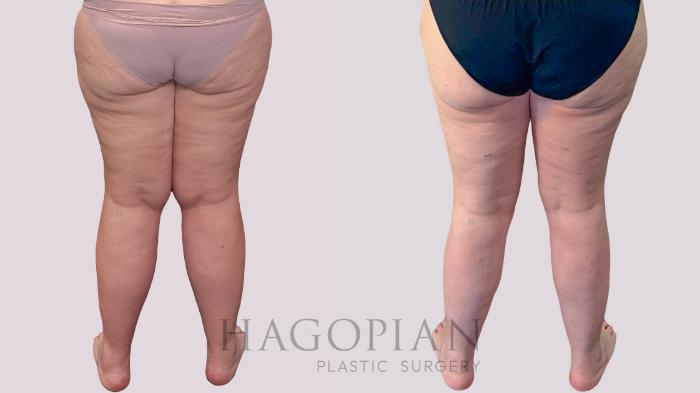 Before & After Thigh Lift Case 293 Left Side View in Atlanta, GA