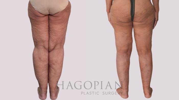 Before & After Thigh Lift Case 296 Back View in Atlanta, GA