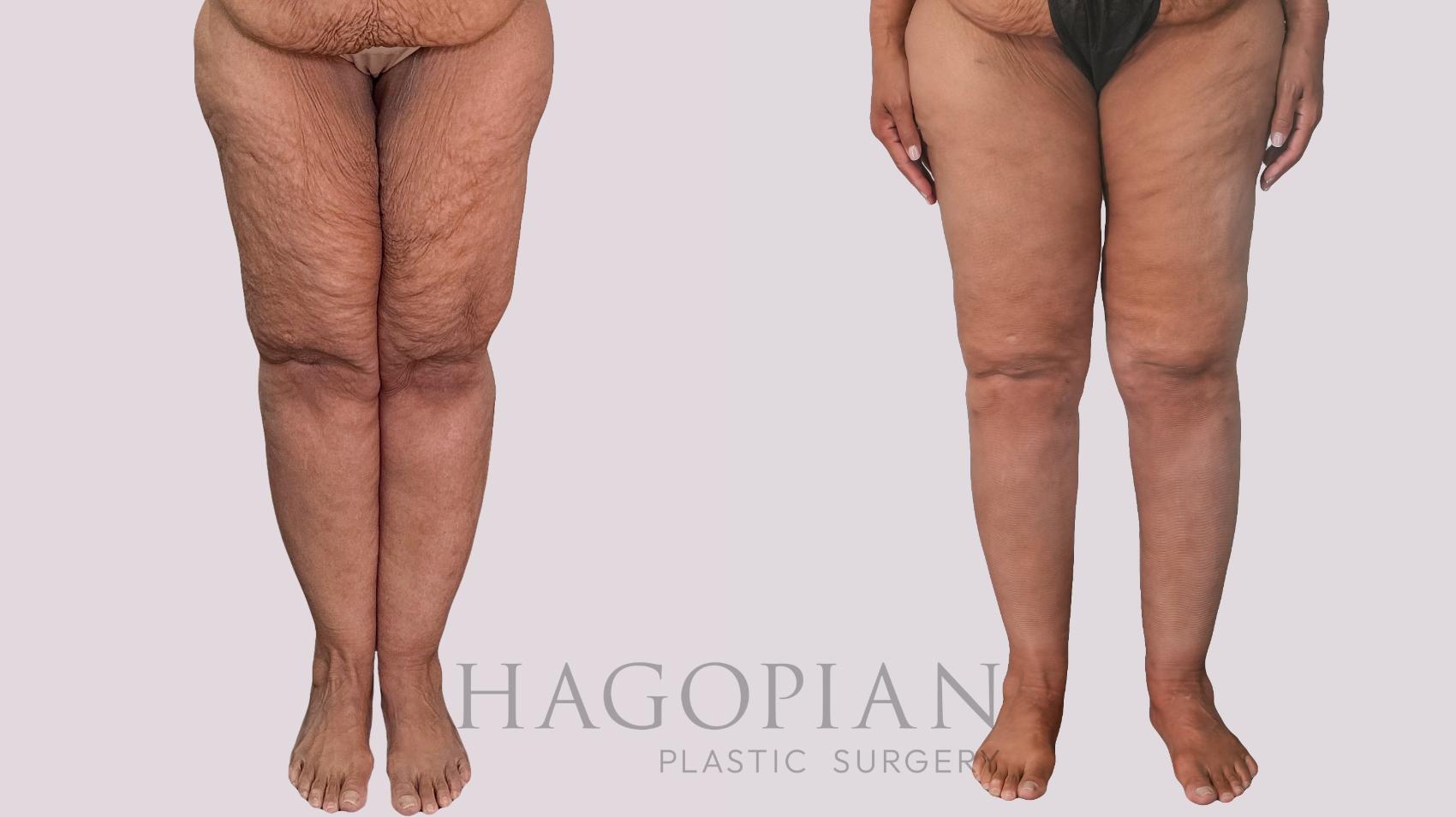 Before & After Thigh Lift Case 296 Front View in Atlanta, GA