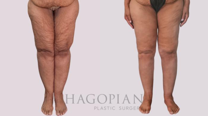 Before & After Thigh Lift Case 296 Front View in Atlanta, GA
