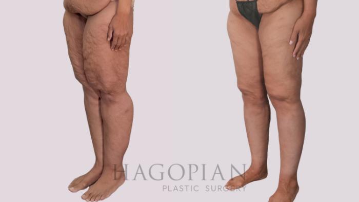 Before & After Thigh Lift Case 296 Left Oblique View in Atlanta, GA