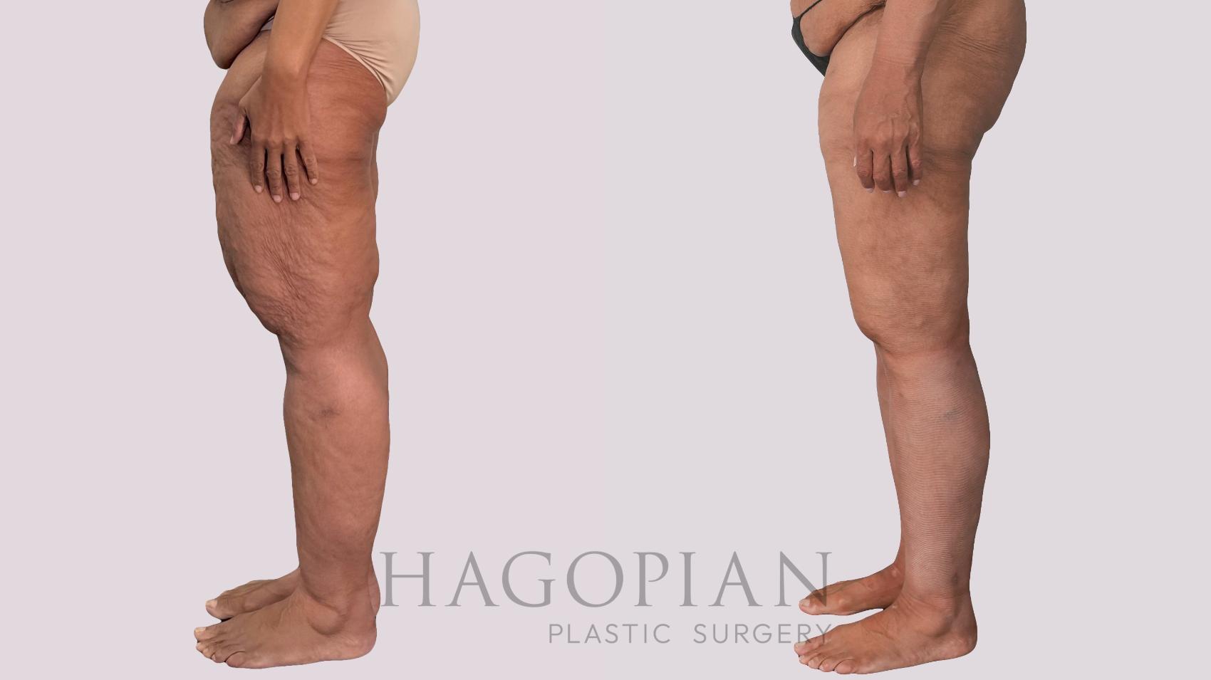 Before & After Thigh Lift Case 296 Left Side View in Atlanta, GA