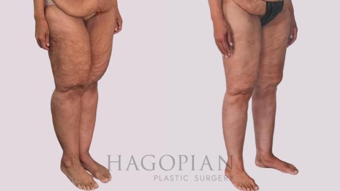 Before & After Thigh Lift Case 296 Right Oblique View in Atlanta, GA