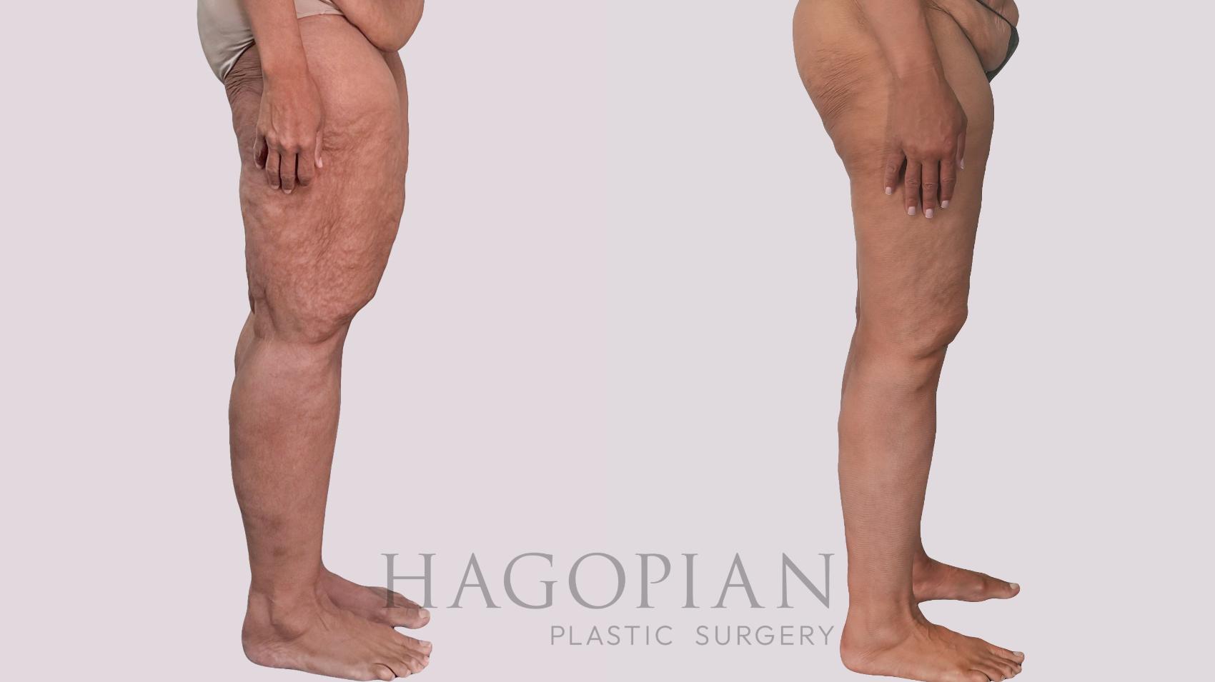 Before & After Thigh Lift Case 296 Right Side View in Atlanta, GA