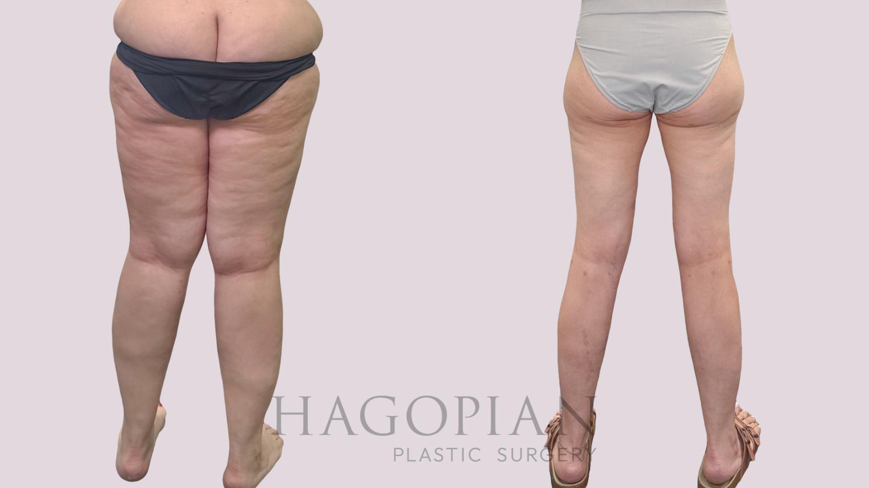 Before & After Thigh Lift Case 302 Back View in Atlanta, GA