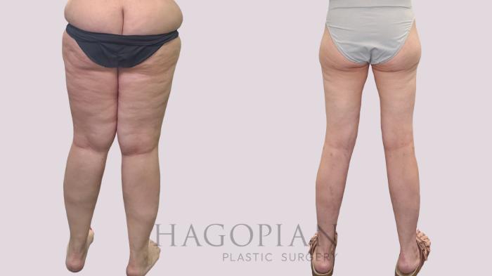 Before & After Thigh Lift Case 302 Back View in Atlanta, GA
