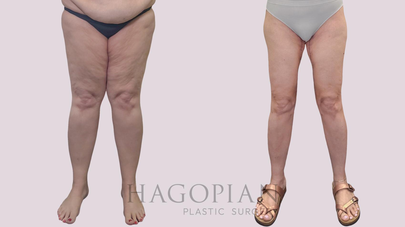 Before & After Thigh Lift Case 302 Front View in Atlanta, GA