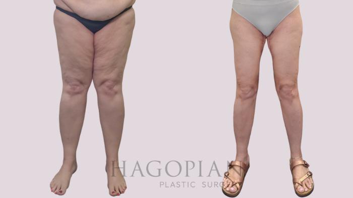 Before & After Thigh Lift Case 302 Front View in Atlanta, GA