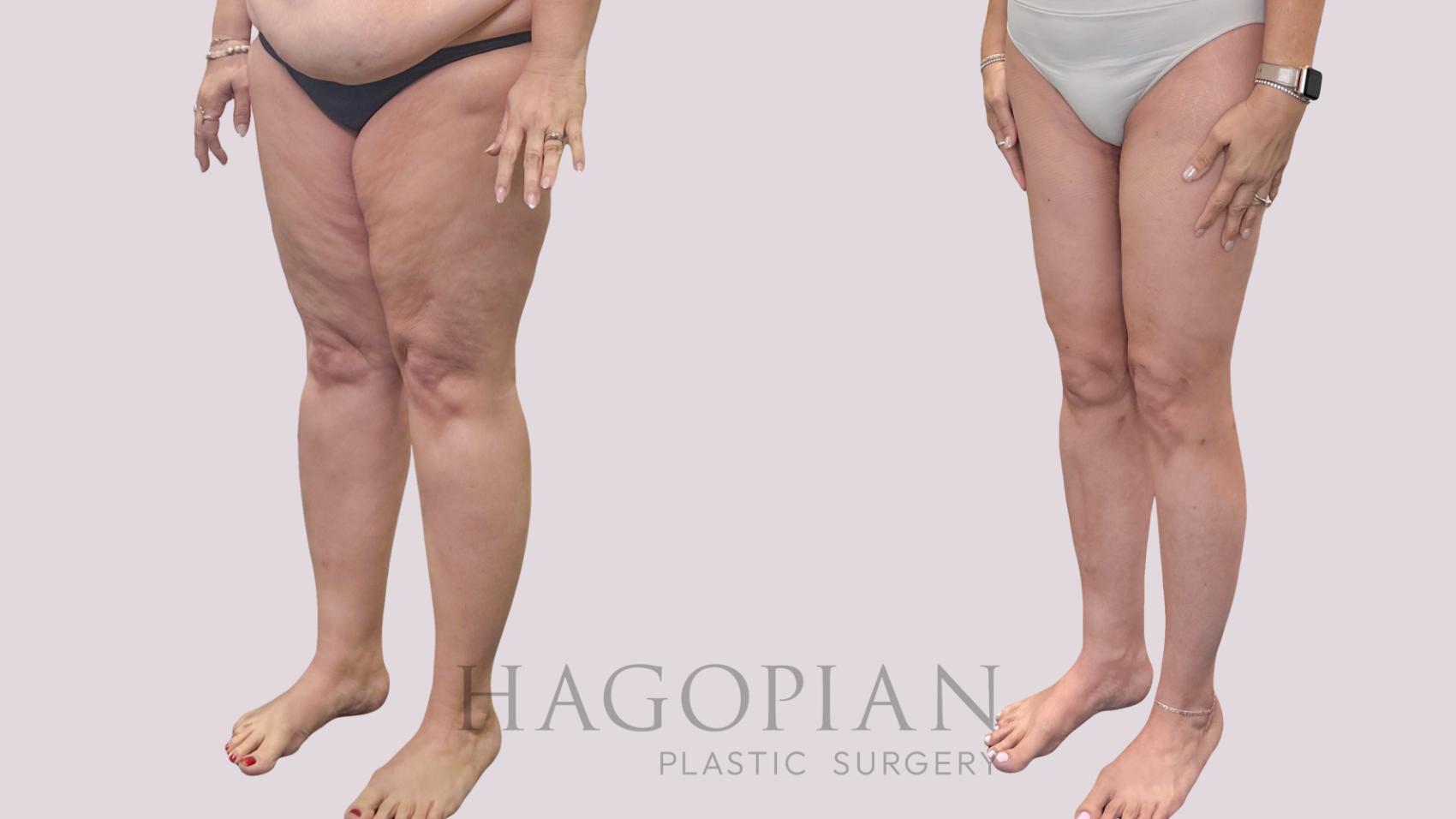 Before & After Thigh Lift Case 302 Left Oblique View in Atlanta, GA
