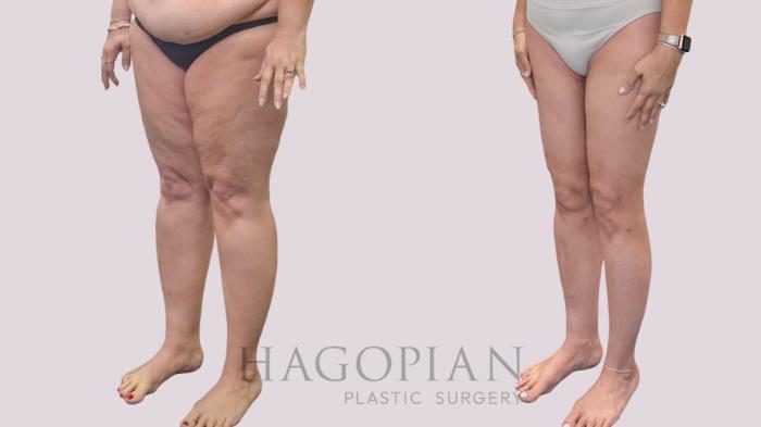 Before & After Thigh Lift Case 302 Left Oblique View in Atlanta, GA