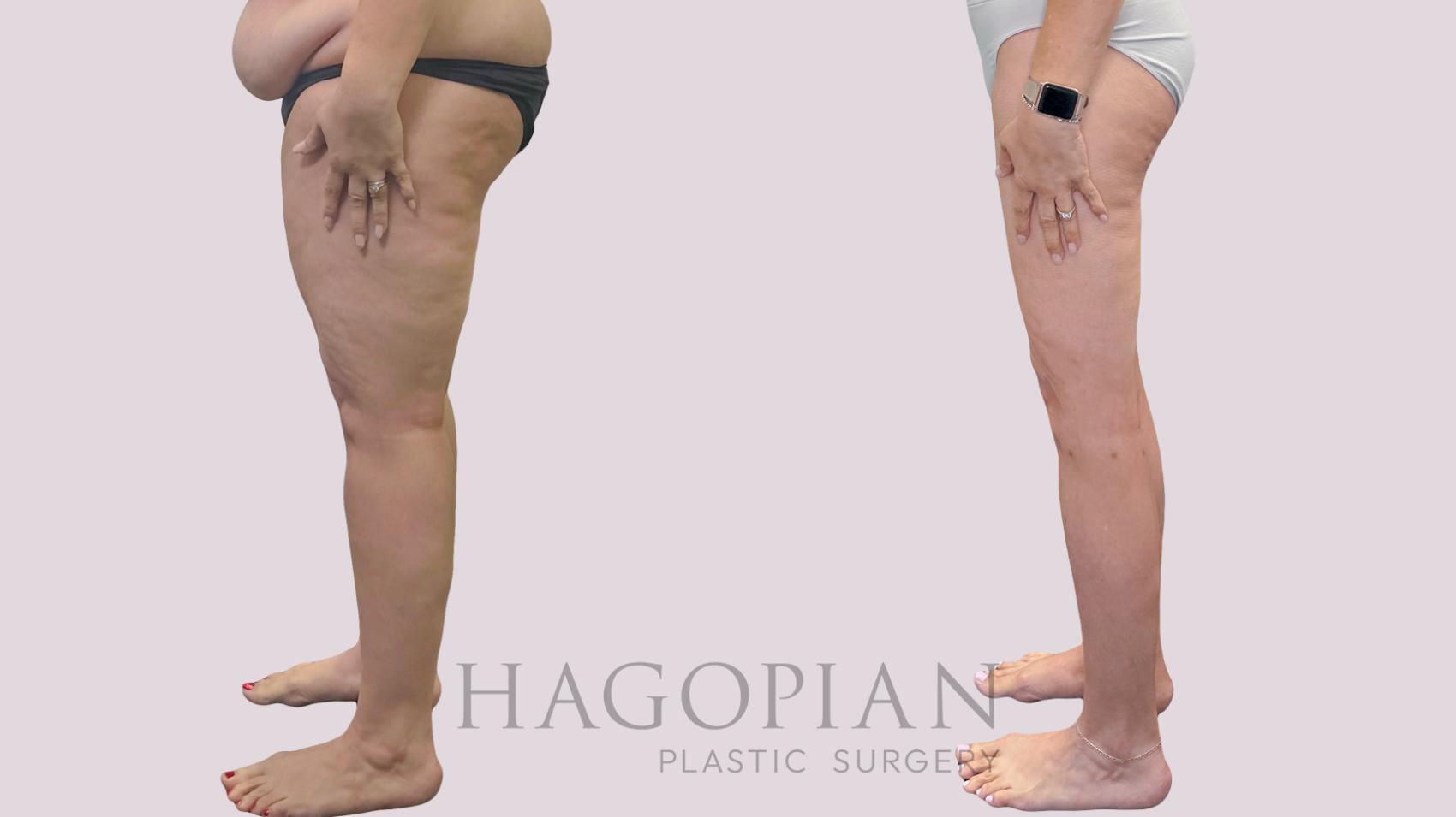 Before & After Thigh Lift Case 302 Left Side View in Atlanta, GA