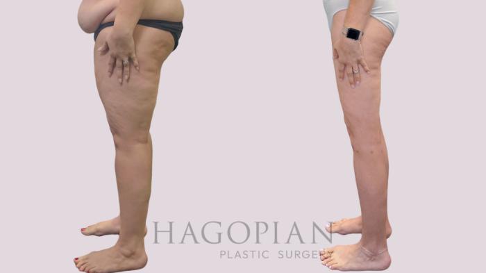 Before & After Thigh Lift Case 302 Left Side View in Atlanta, GA