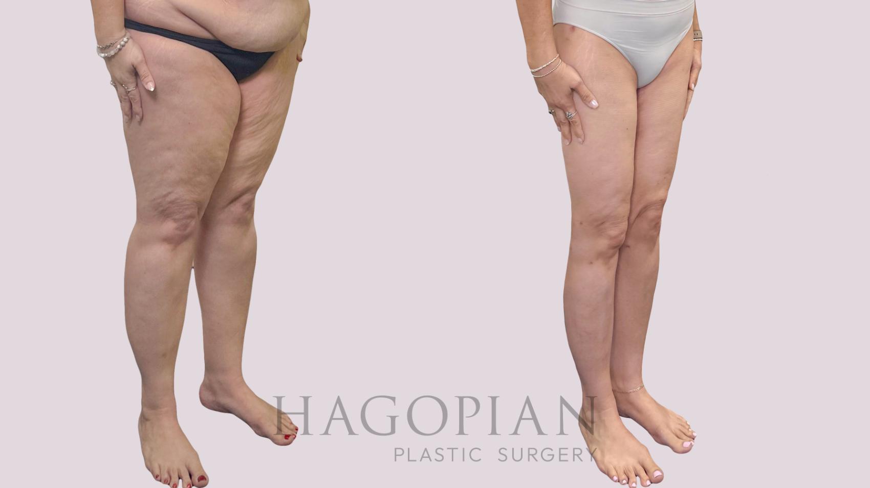 Before & After Thigh Lift Case 302 Right Oblique View in Atlanta, GA