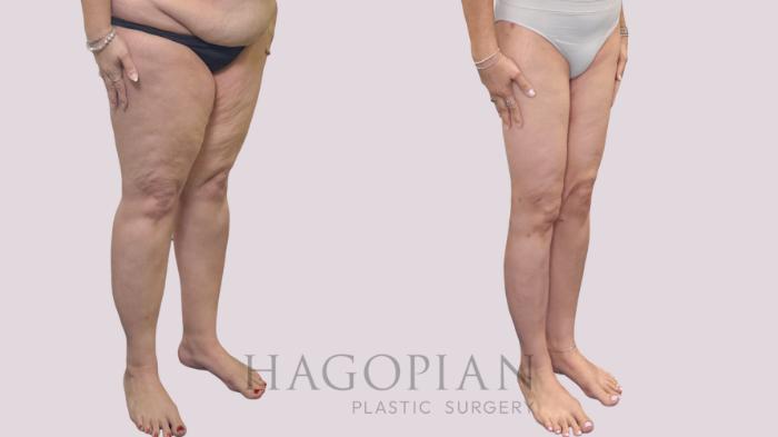 Before & After Thigh Lift Case 302 Right Oblique View in Atlanta, GA