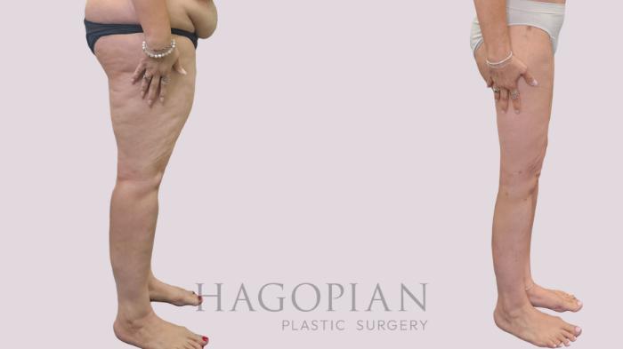 Before & After Thigh Lift Case 302 Right Side View in Atlanta, GA