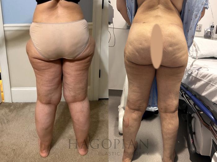 Before & After Thigh Lift Case 85 Back View in Atlanta, GA