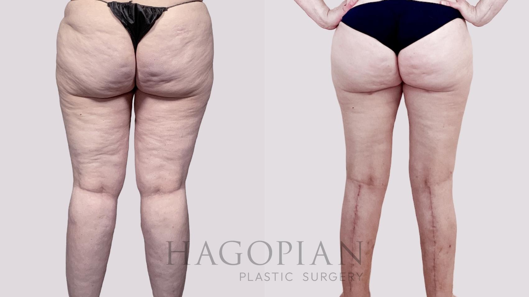 Before & After Thigh Lift Case 88 Back View in Atlanta, GA