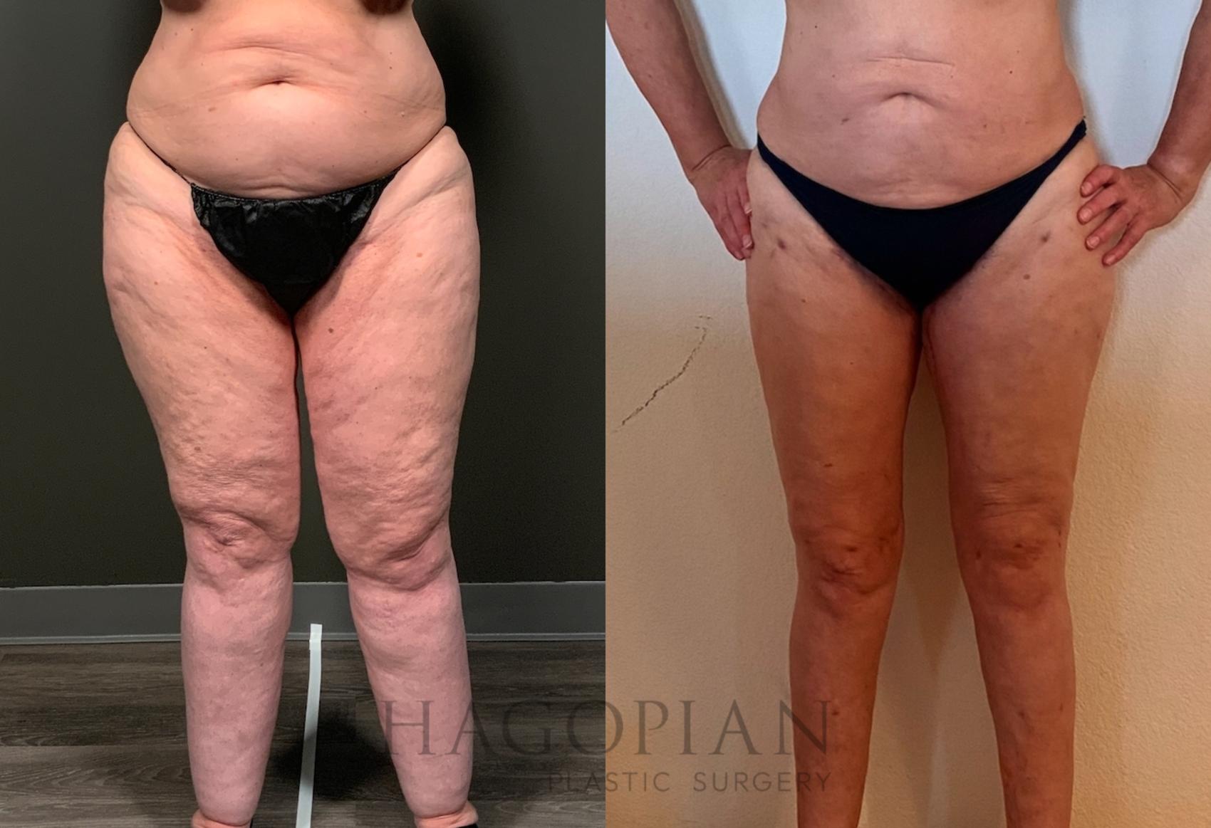 Before & After Thigh Lift Case 88 Front View in Atlanta, GA