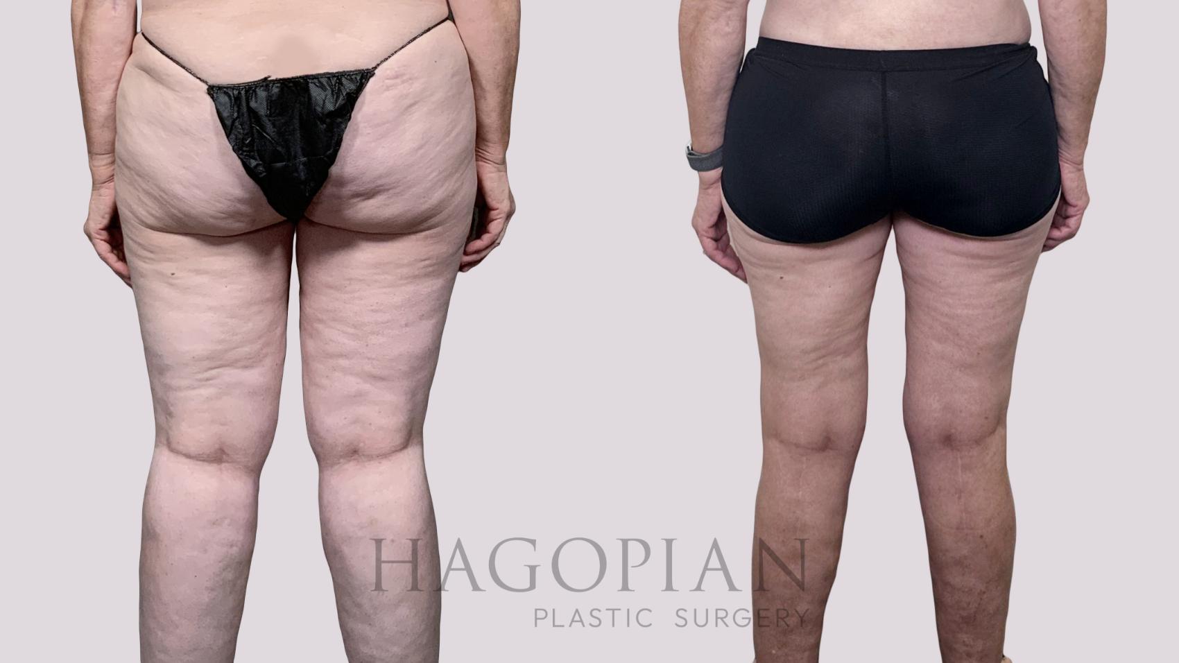 Before & After Thigh Lift Case 90 Back View in Atlanta, GA