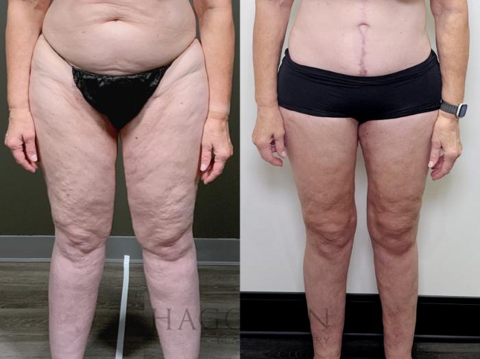 Before & After Thigh Lift Case 90 Front View in Atlanta, GA