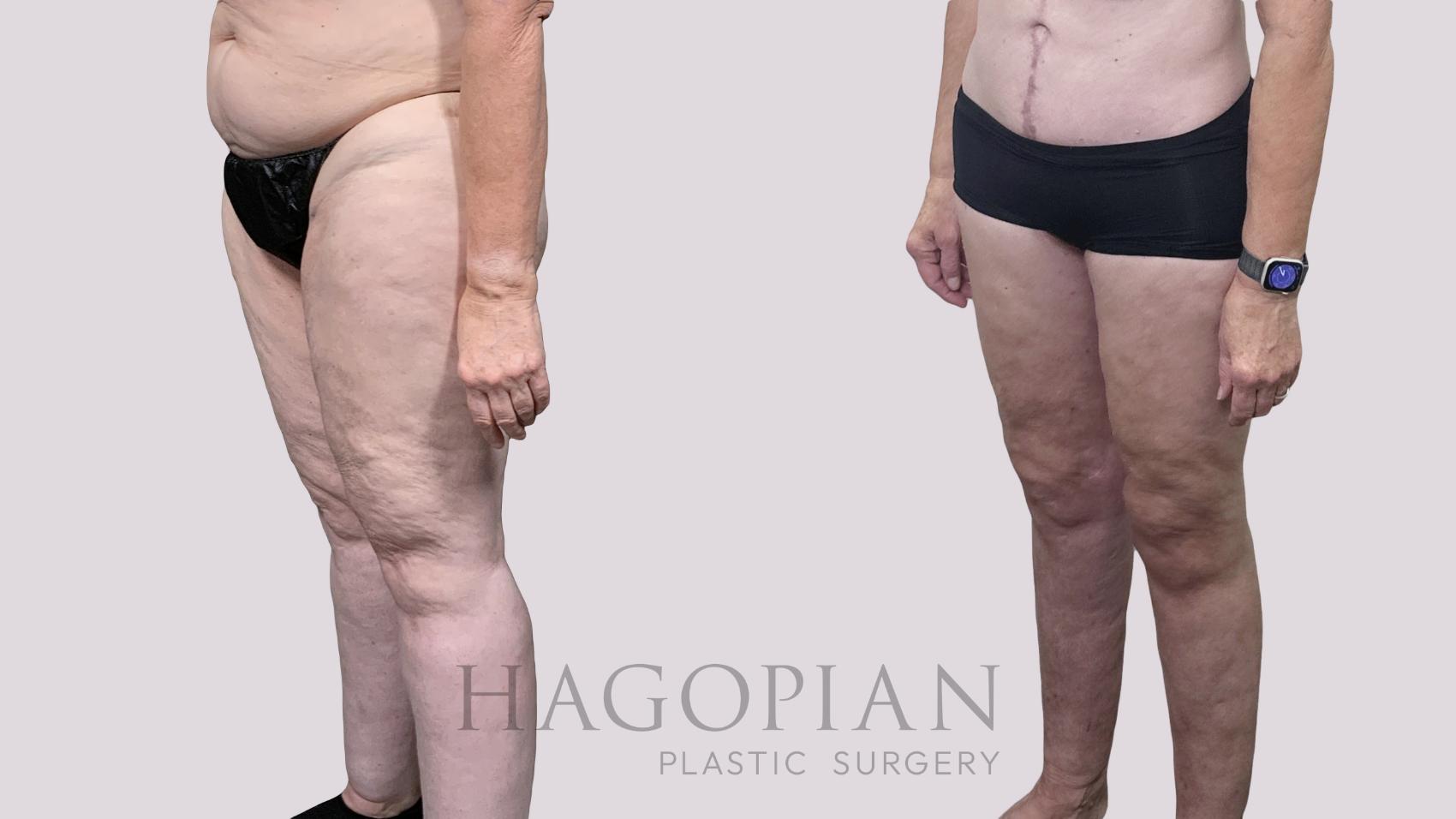 Before & After Thigh Lift Case 90 Left Oblique View in Atlanta, GA