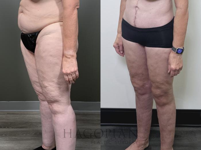 Before & After Thigh Lift Case 90 Left Oblique View in Atlanta, GA