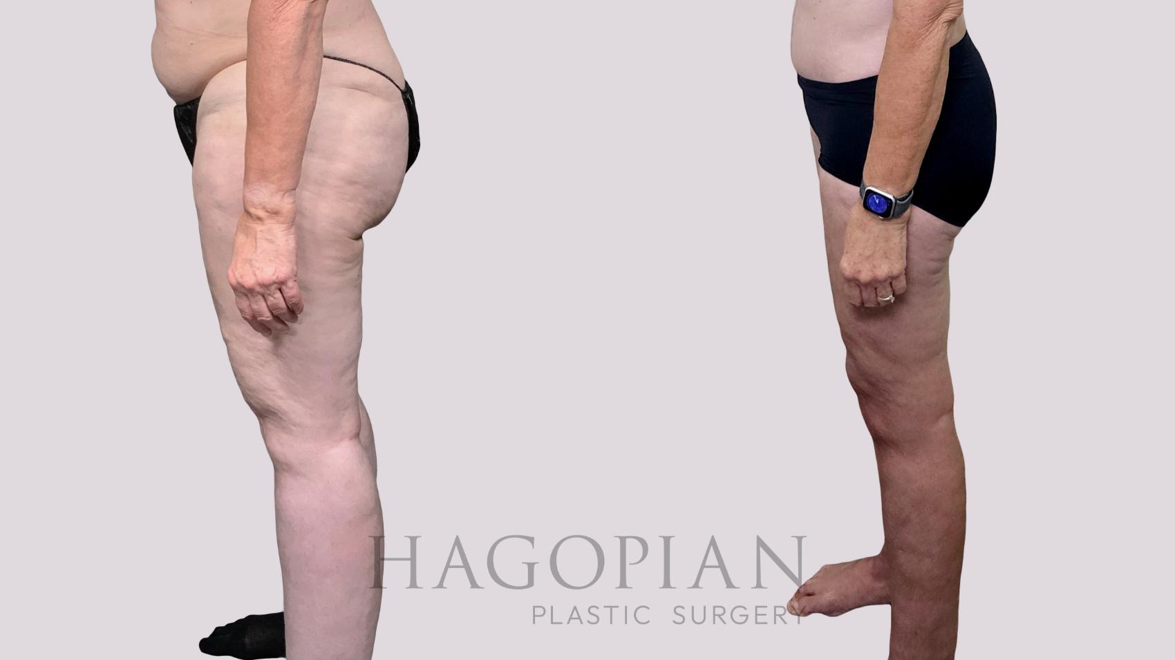 Before & After Thigh Lift Case 90 Left Side View in Atlanta, GA