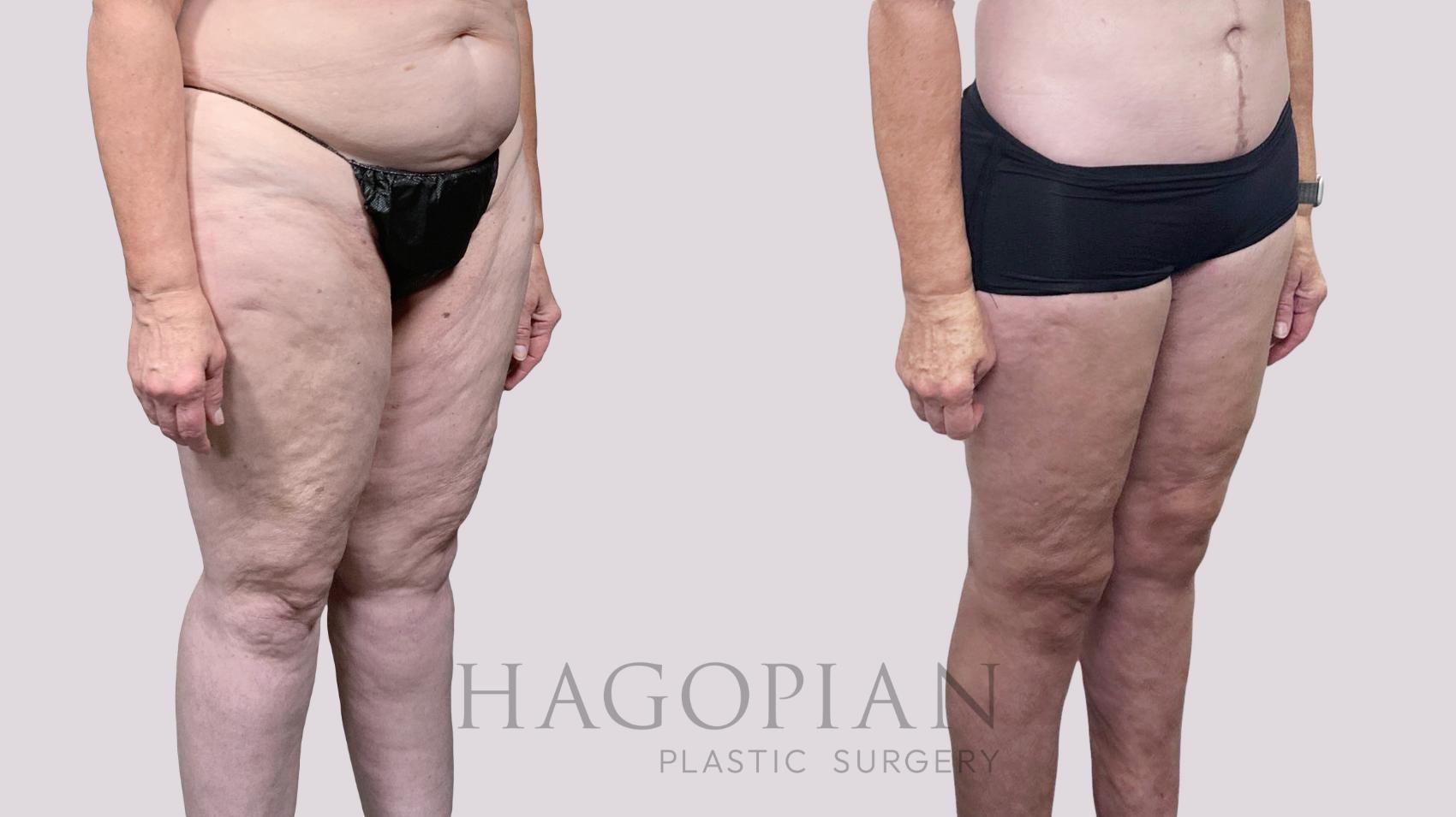 Before & After Thigh Lift Case 90 Right Oblique View in Atlanta, GA