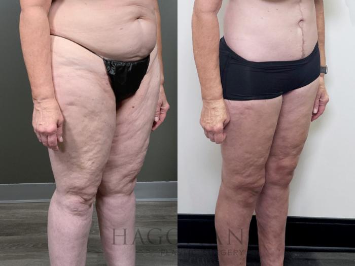 Before & After Thigh Lift Case 90 Right Oblique View in Atlanta, GA