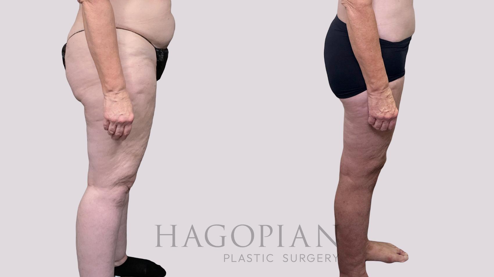 Before & After Thigh Lift Case 90 Right Side View in Atlanta, GA