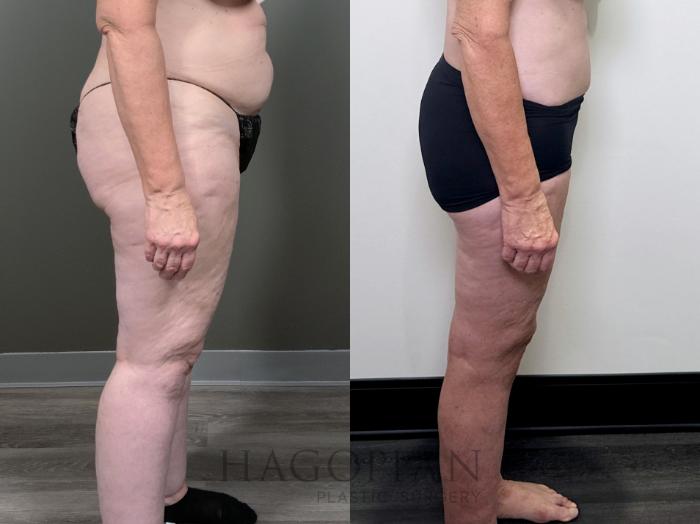 Before & After Thigh Lift Case 90 Right Side View in Atlanta, GA